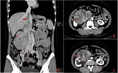 Treatment of renal leiomyosarcoma with right atrial tumor embolus without cardiopulmonary bypass: a case report